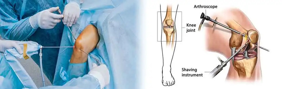 Arthroscopic Surgeon result