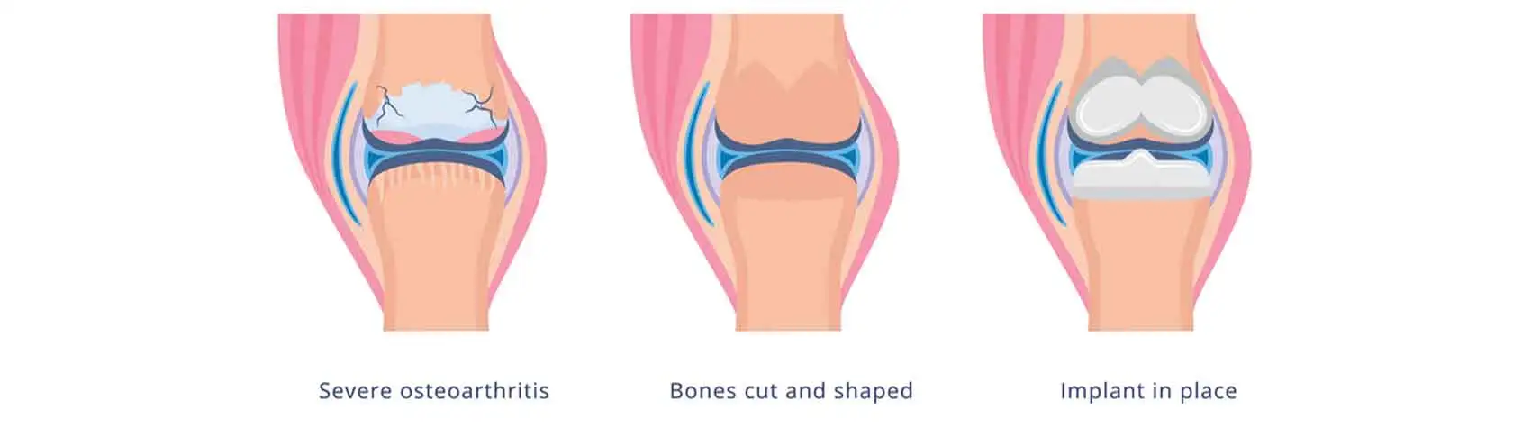 best knee replacement surgery in srinagar, kashmir