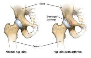 hip replacement surgery in ferozpur