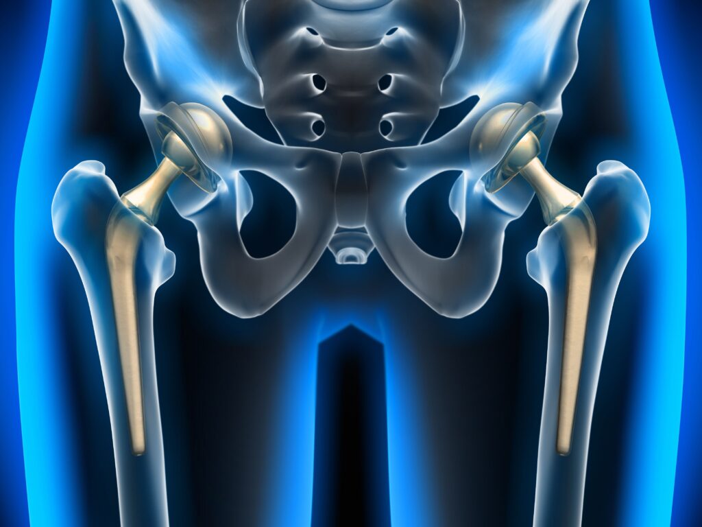 hip replacement surgery in ferozpur